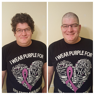 Our host of the Brain Ablaze Epilepsy Podcast, David Clifford, in a before and after picture after shaving his head before brain surgery.